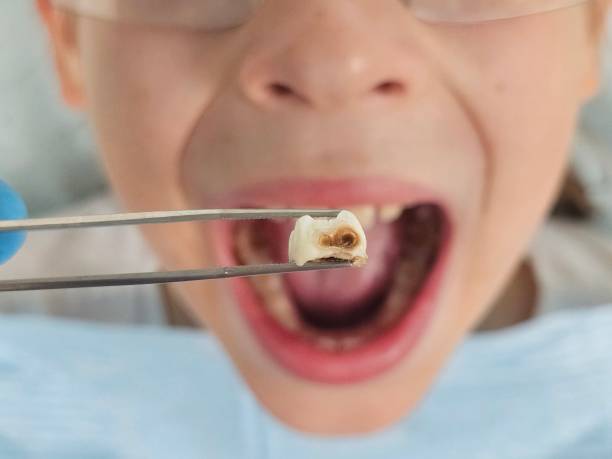 Best Emergency Root Canal Treatment in Exeter, CA